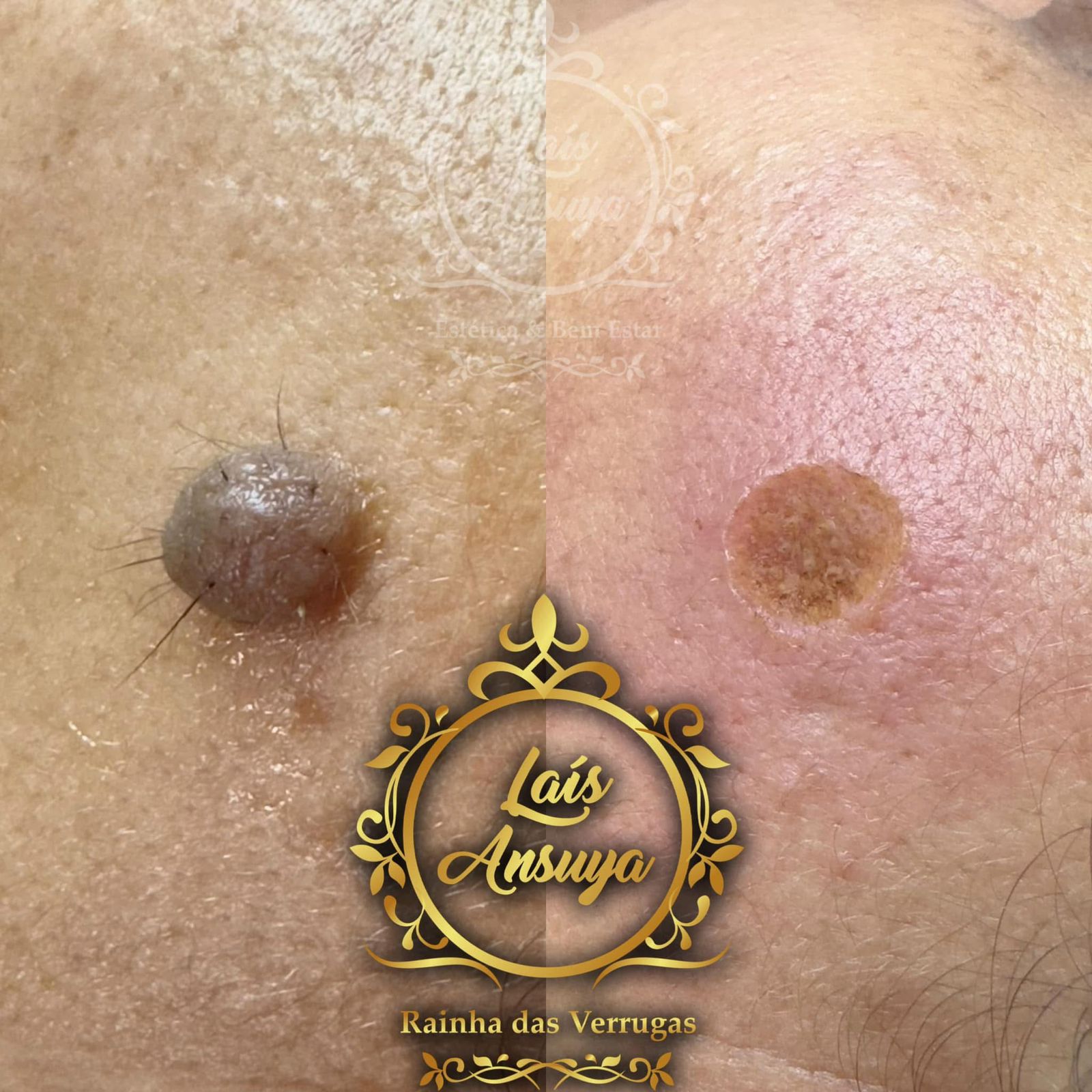 Antes e depois 2 - remoção de verruga