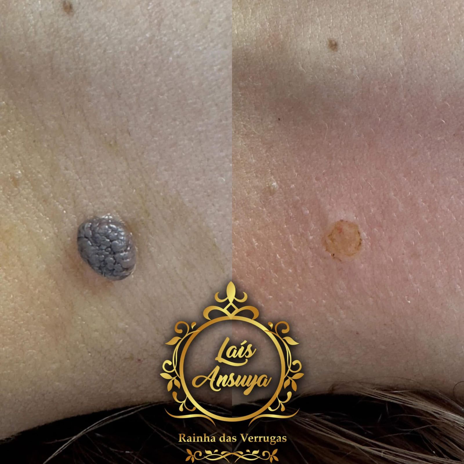 Antes e depois 3 - remoção de verruga