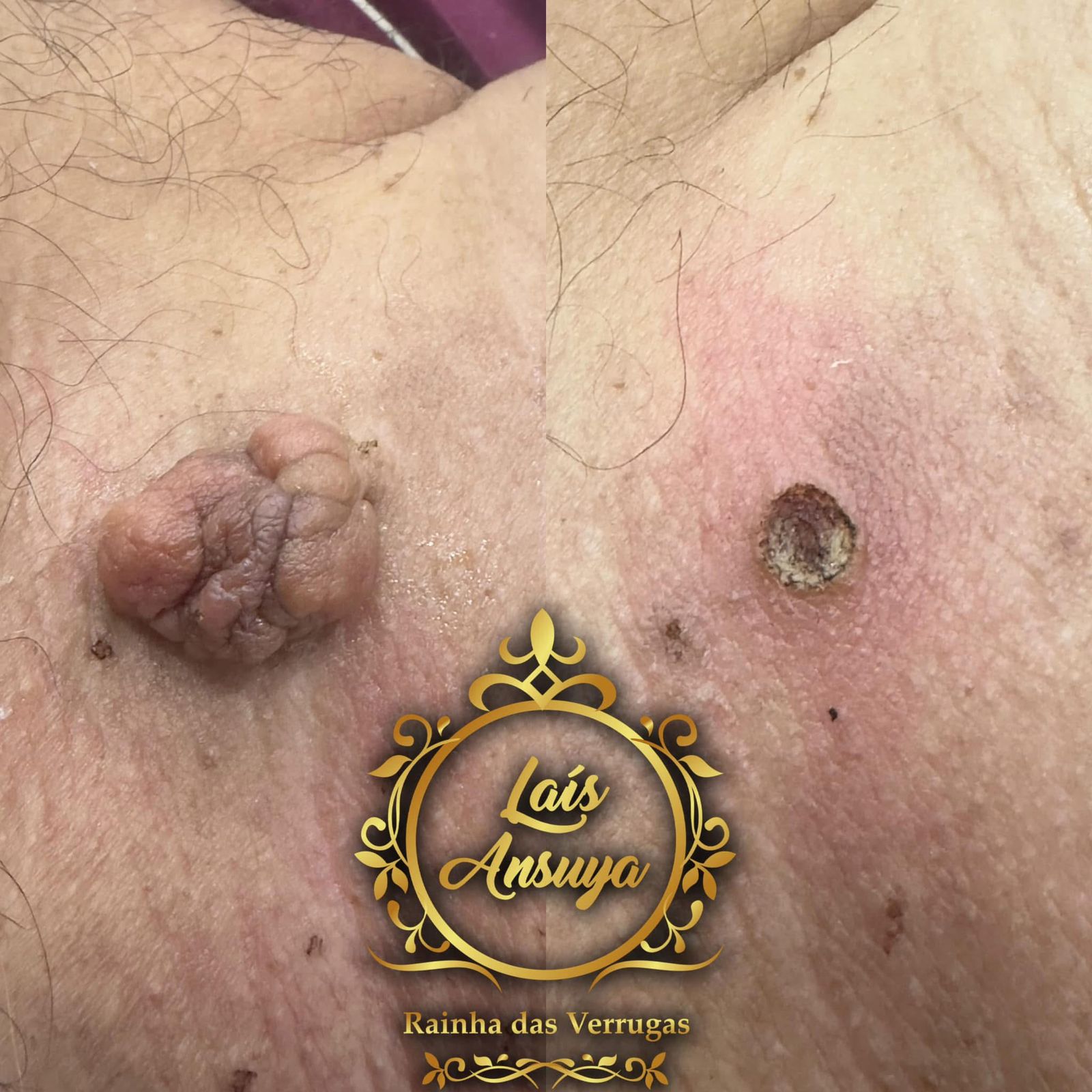 Antes e depois 4 - remoção de verruga