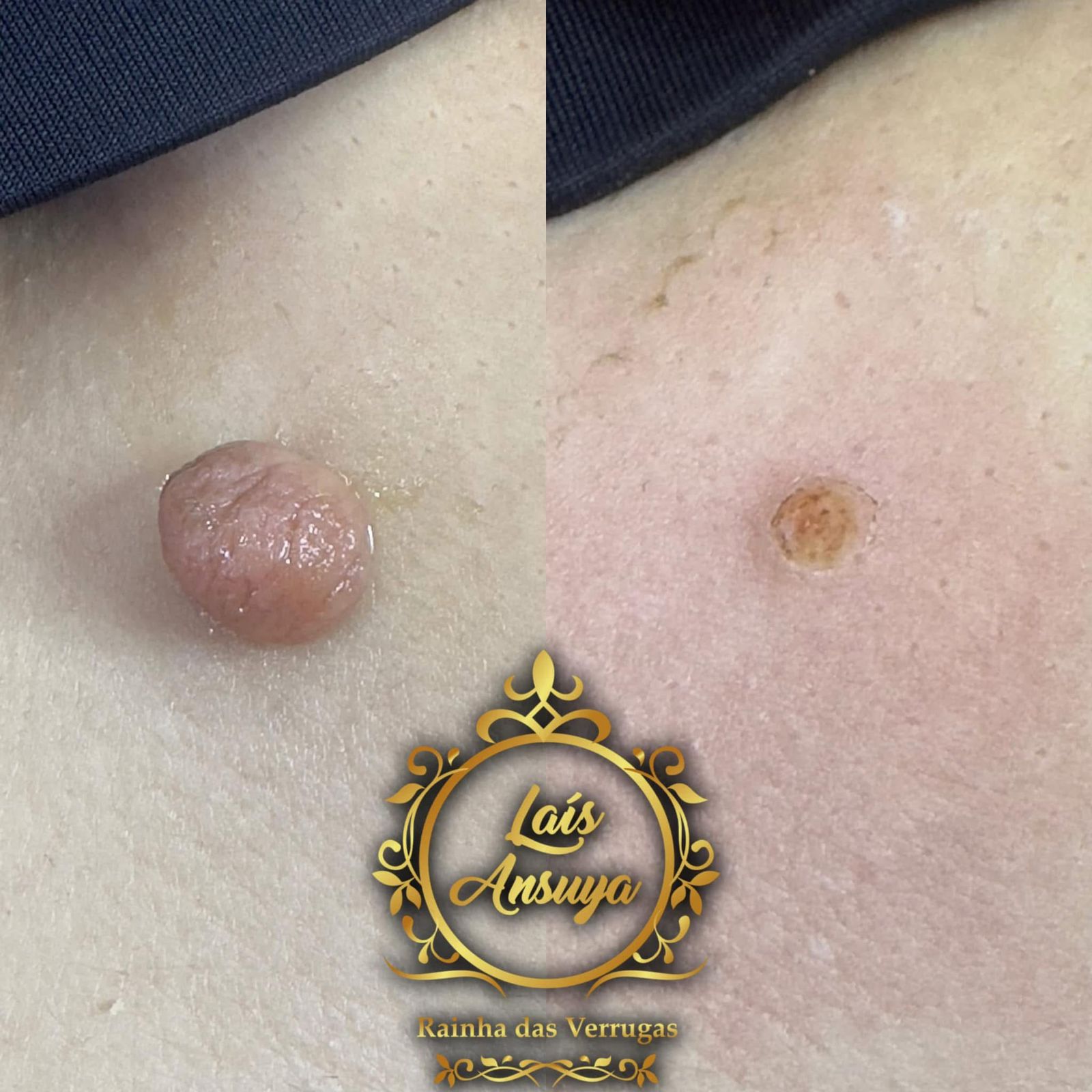 Antes e depois 5 - remoção de verruga