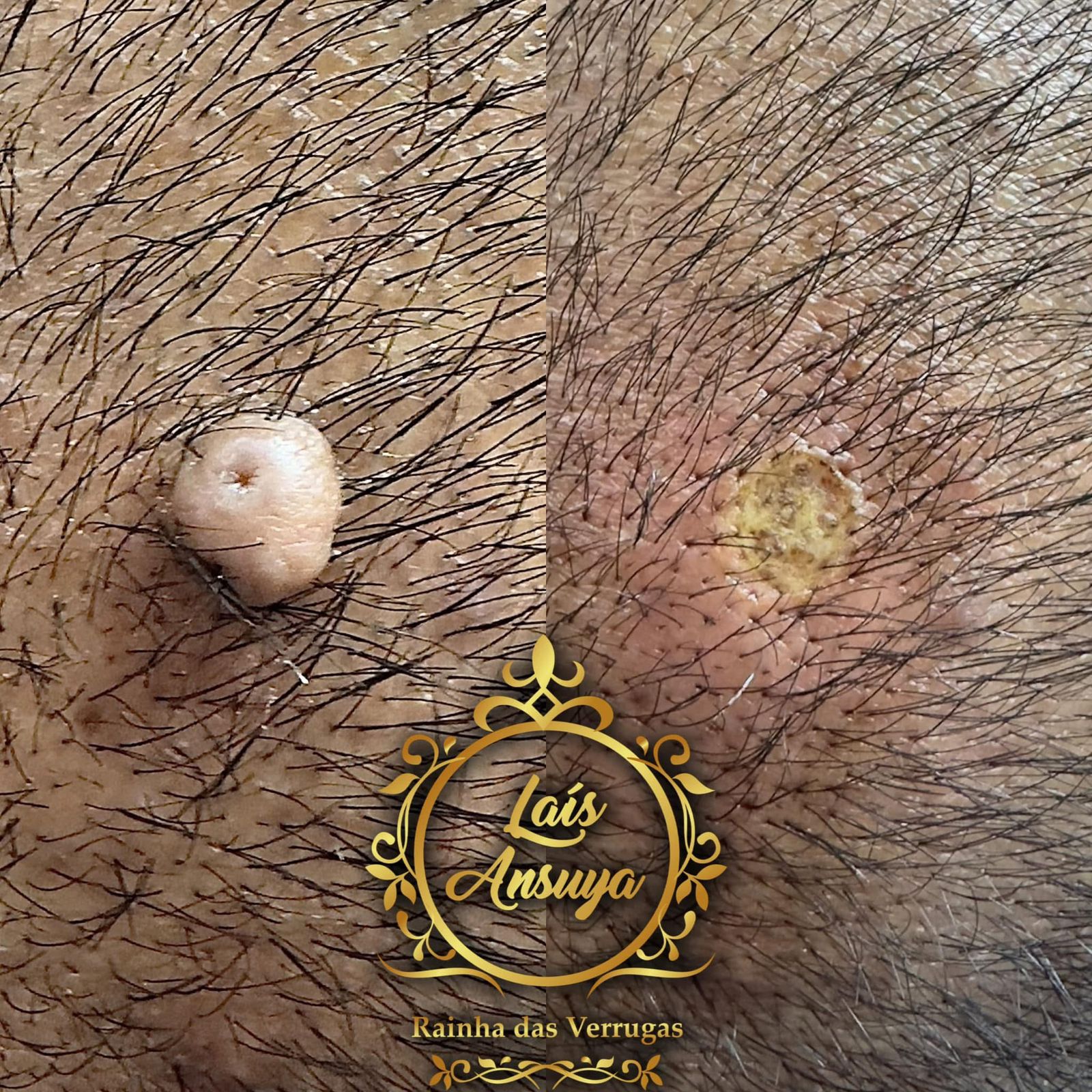 Antes e depois 6 - remoção de verruga